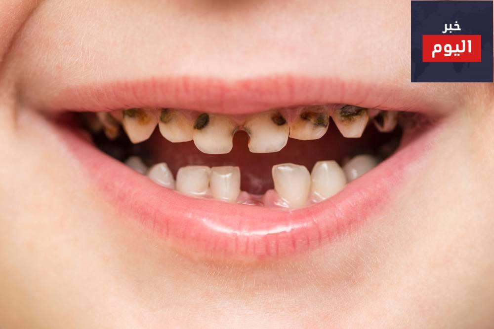 افضل علاج تسوس الاسنان