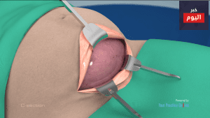 الولادة القيصرية - C-section
