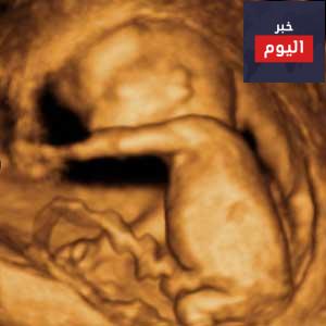 فحوصات الكشف عن متلازمة داون - Screening and diagnostic tests for Down's syndrome