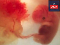نزيف الحمل - Vaginal bleeding in pregnancy