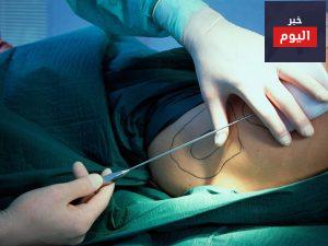 التعافي بعد مصّ الشحم - Recovering after liposuction