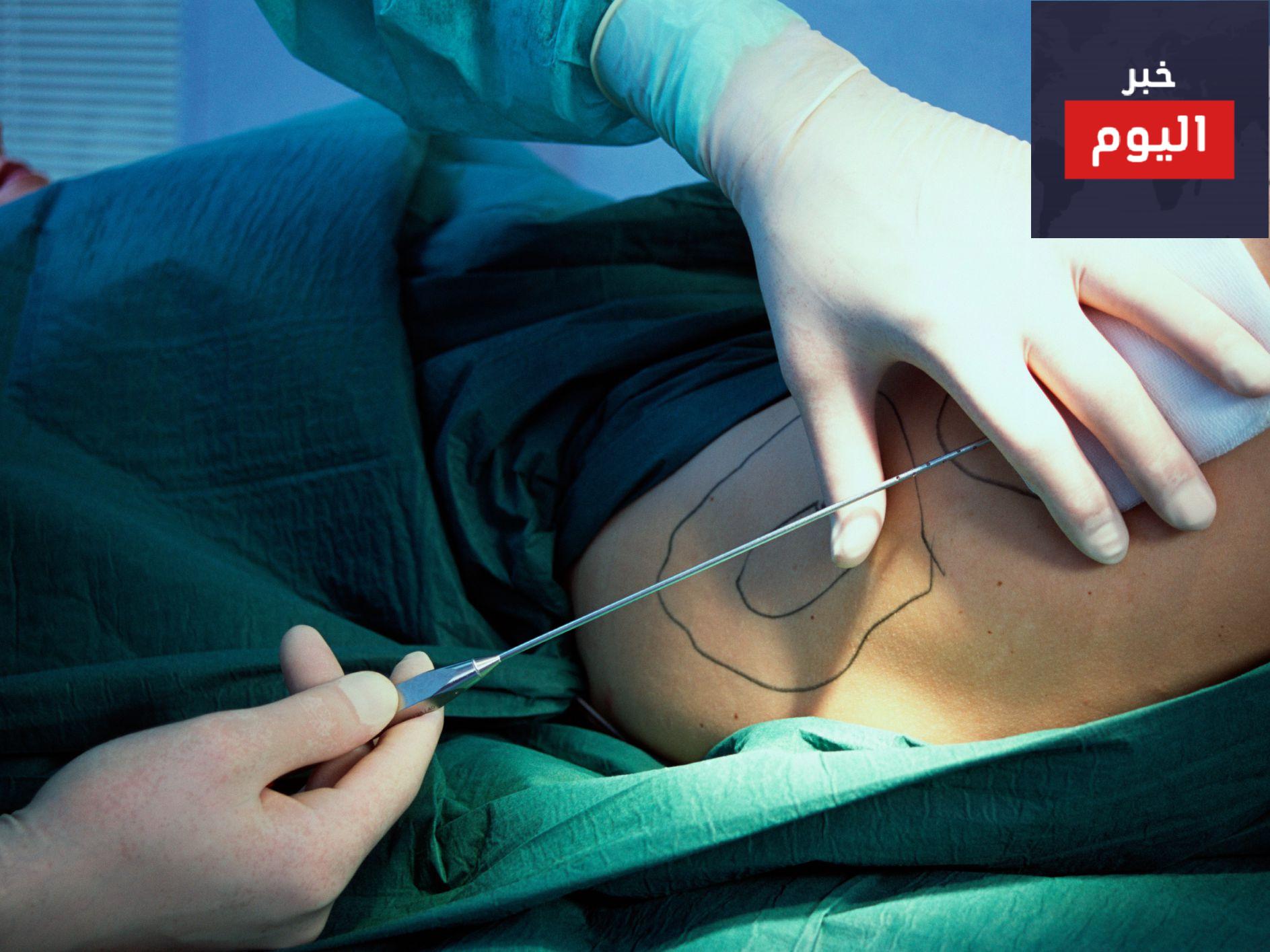 التعافي بعد مصّ الشحم - Recovering after liposuction