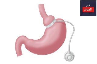 قصة نور: 'عمليتي الجراحية لربط المعدة' - Noor's story: 'My gastric band surgery'