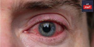 احمرار العين - Eye Redness