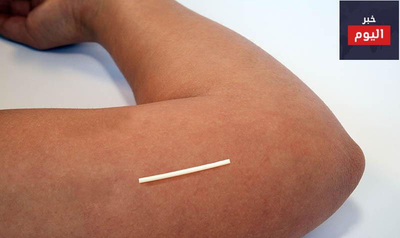 مانع الحمل المزروع - Contraceptive Implant