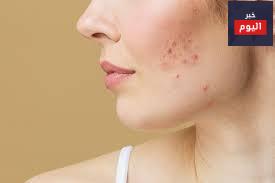 حب الشباب - Acne