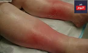 قرحة الساق الوريدية - Venous leg ulcer