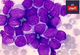 ابيضاض الدم اللمفاوي الحاد - Acute Lymphoblastic Leukaemia