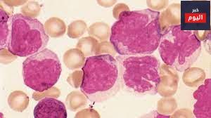 ابيضاض الدم النخاعي المزمن ابيضاض الدم النخاعي المزمن - Chronic myeloid leukaemia