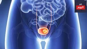سرطان المثانة - Bladder cancer