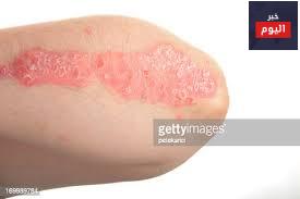 الصُداف - Psoriasis