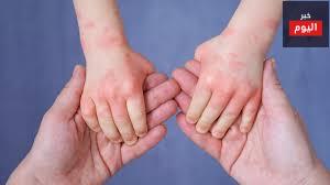 الإكزيما التأتبية - Eczema