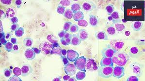 نقص فيتامين ب 12 أو نقص حمض الفوليك - Vit B12 & Folate deficiency