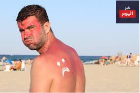 حروق الشمس - Sunburn