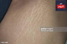 علامات التشقق - Stretch marks