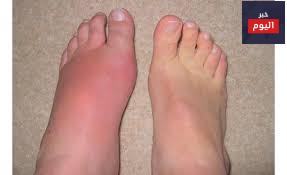 النقرس - Gout