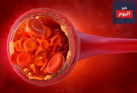 ارتفاع الكوليسترول - High cholesterol