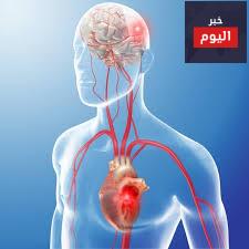 الرجفان الأذيني - AF