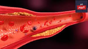 تصلب الشرايين - Atherosclerosis