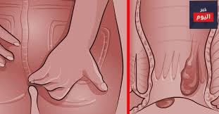 البواسير - Haemorrhoids