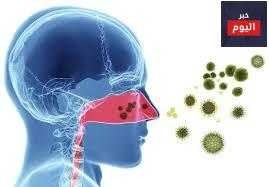 التهاب الأنف التحسسي - Allergic rhinitis
