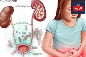 إنتان السبيل البولي - Urinary tract infection