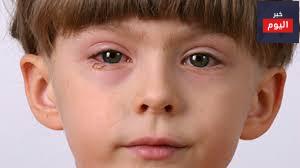 التهاب الملتحمة - Conjunctivitis