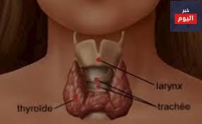 قصور الغدة الدرقية - Hypothyroidism