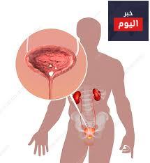 حصيات المثانة - Bladder stones