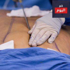 كيفية إجراء مصّ الشحم - How liposuction is performed