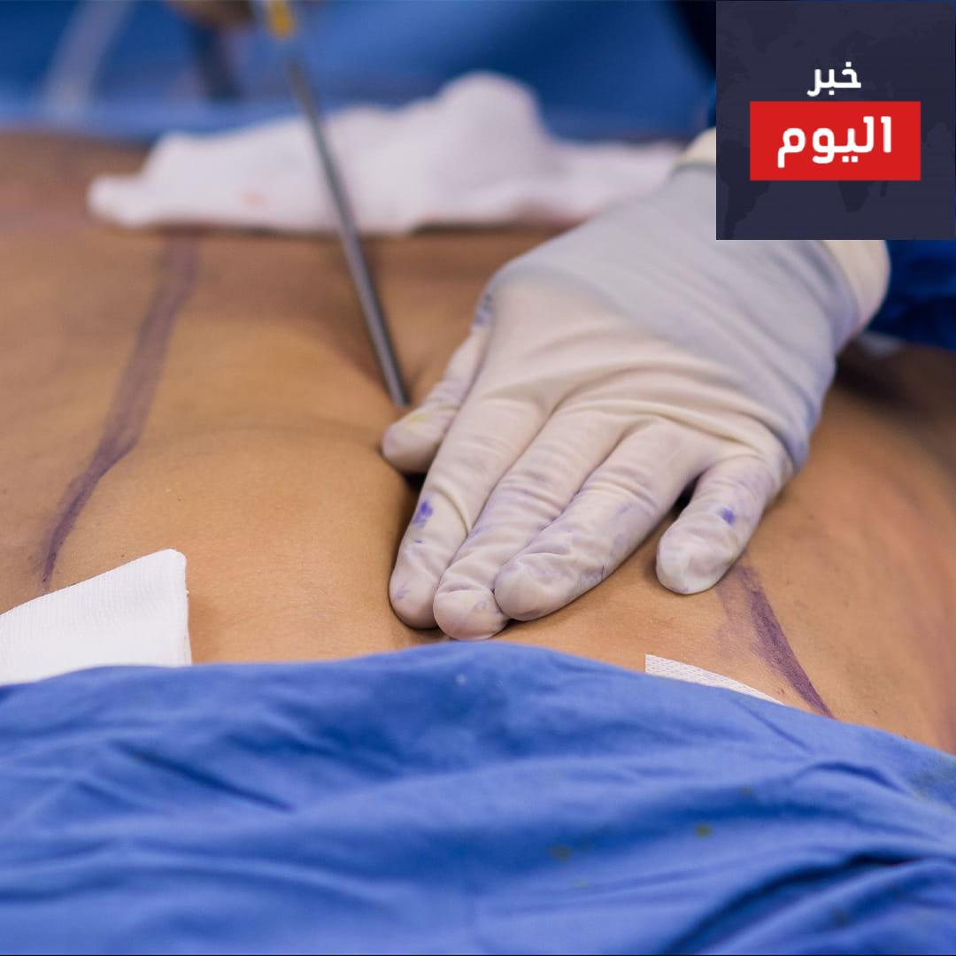 كيفية إجراء مصّ الشحم - How liposuction is performed