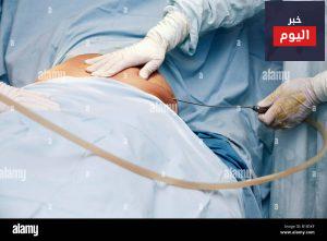 مخاطر مصّ الشحم - Risks of liposuction