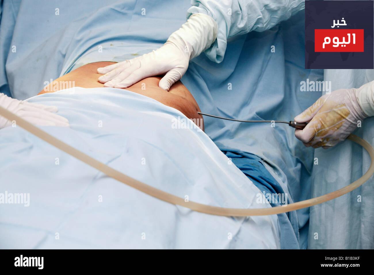 مخاطر مصّ الشحم - Risks of liposuction