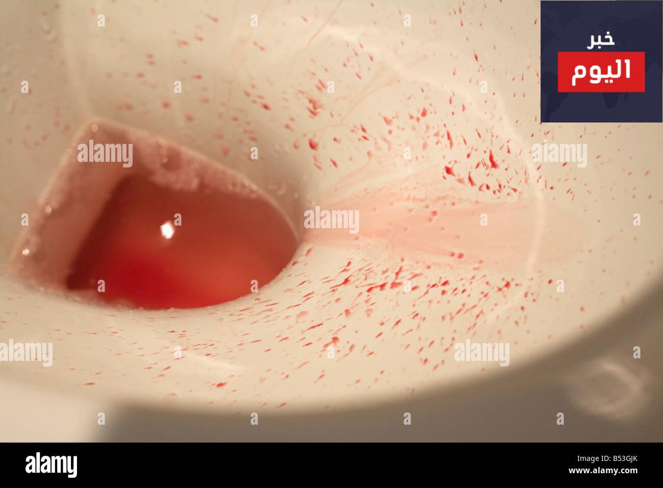 دم في البول (البيلة الدّمويّة) - Blood in Urine