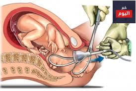 الولادة بالملقط أو بالشفط - Forceps or vacuum delivery