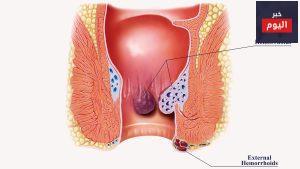 البواسير أثناء الحمل - Piles in pregnancy