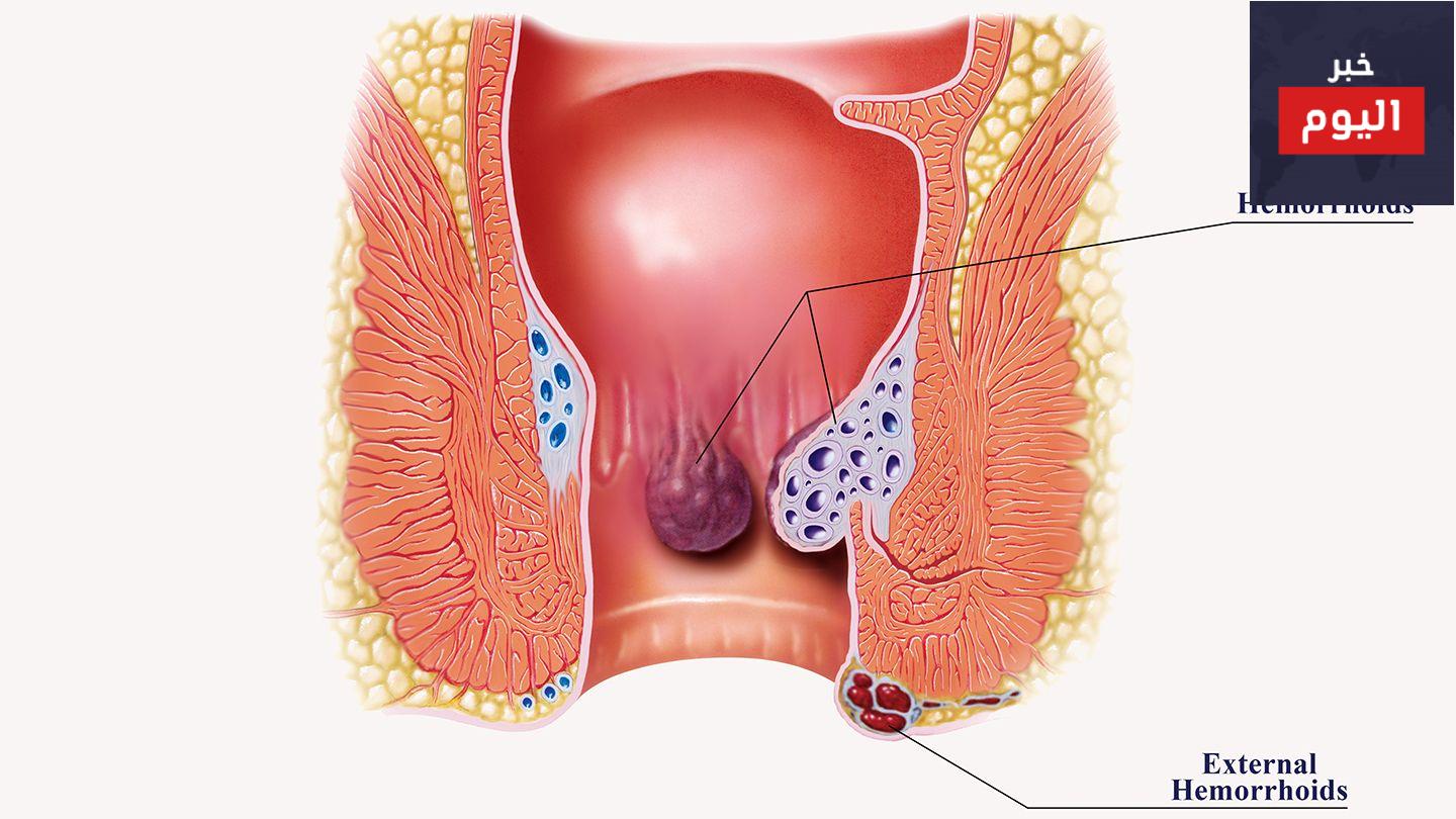 البواسير أثناء الحمل - Piles in pregnancy