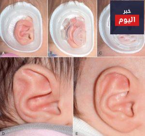 أسباب تشوهات صيوان الأذن وطرق التجميل