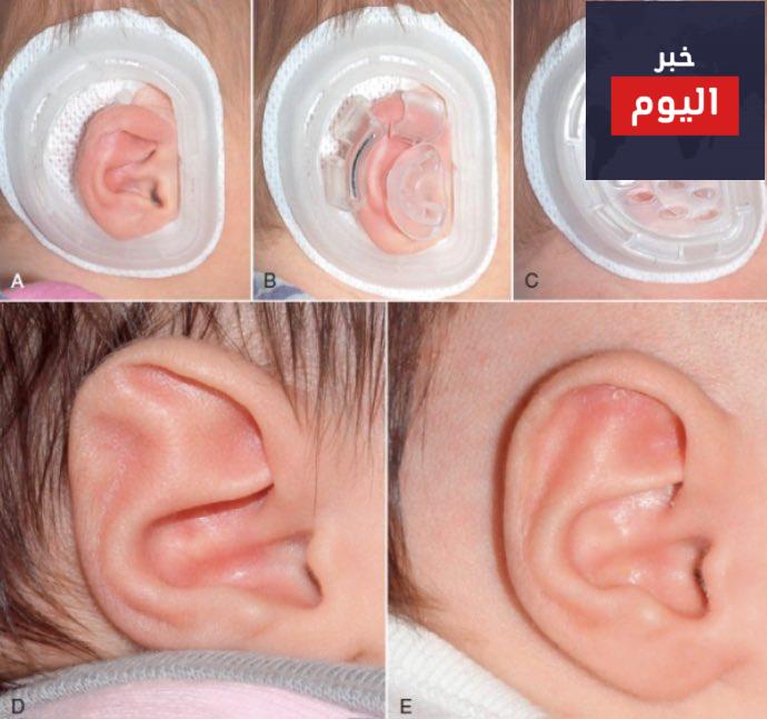 أسباب تشوهات صيوان الأذن وطرق التجميل