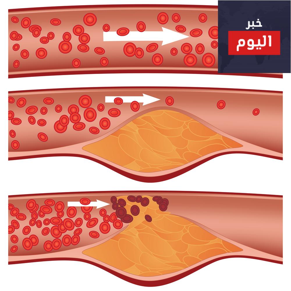 أعراض مرض الكوليسترول