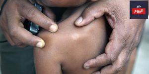 أعراض مرض الجذام