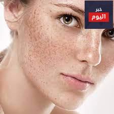 خلطات لازالة النمش