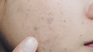 تخلصي من أثار حب الشباب وتجنبي ظهورها