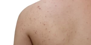 خلطات طبيعية للتخلص من حبوب الظهر