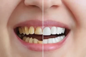 طريقة سريعة لتبييض الاسنان