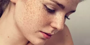 طرق إزالة النمش من الوجه