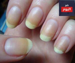 طرقٌ فعّالة لإزالة اللون الأصفر عن أظافرك