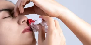 طريقة وقف نزيف الانف