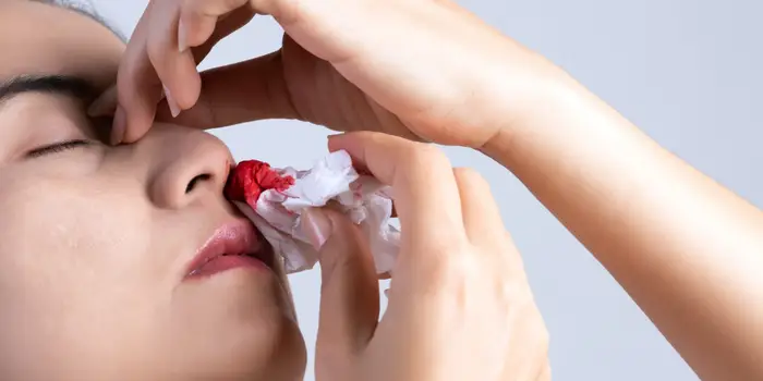طريقة وقف نزيف الانف