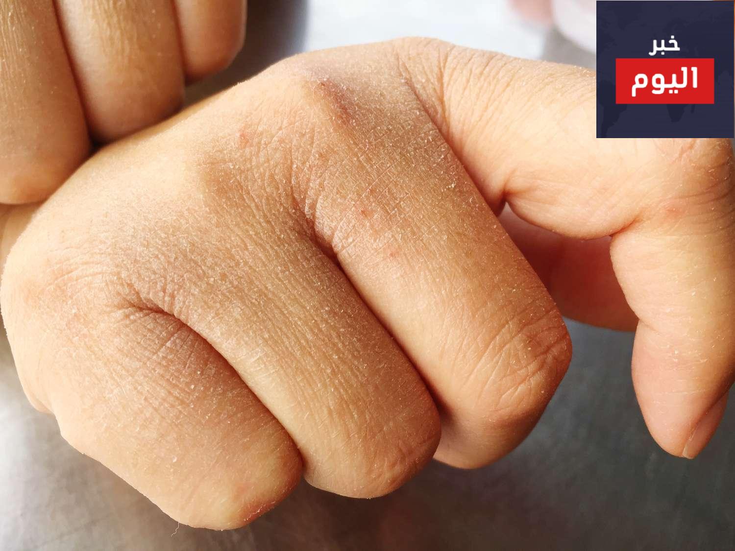 علاج تشقق اليدين